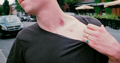 tit hickey|Whats with the hickeys and why do we love them so。